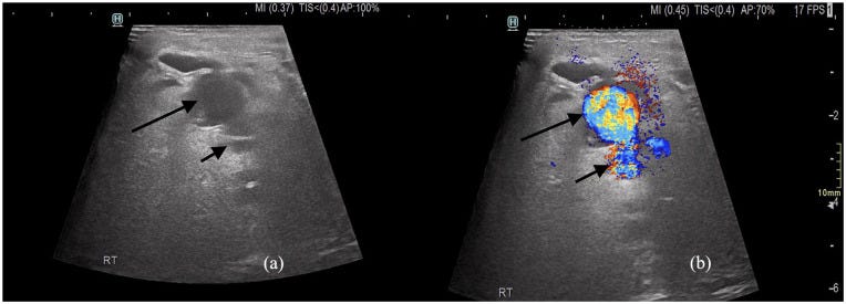 Hernia tempo formacion 2.jpg
